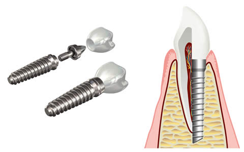 Dental Implant Aftercare – Advice From The Acton Vale Team