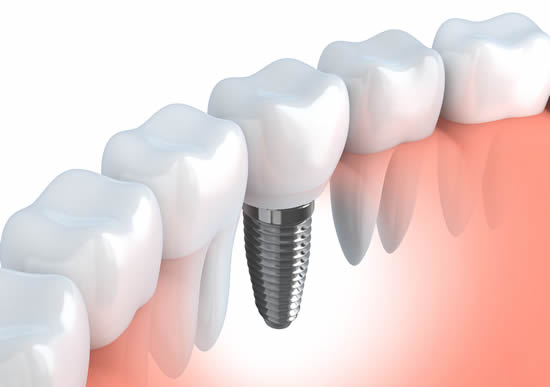 New Dental Implants Near Chiswick – Useful Q & A’s
