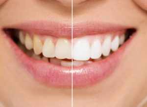 Before after whiter teeth