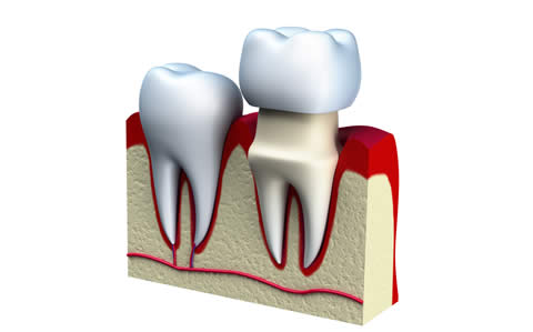 Ceramic Crowns And More At Your Dentist Near Chiswick